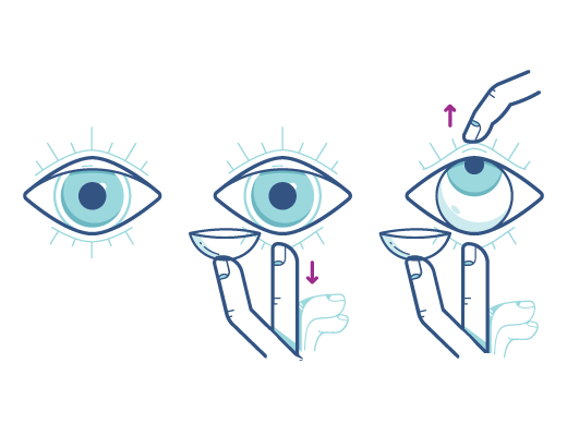Befolgen Sie die Anleitung zum Einsetzen der Kontaktlinse in Ihr Auge