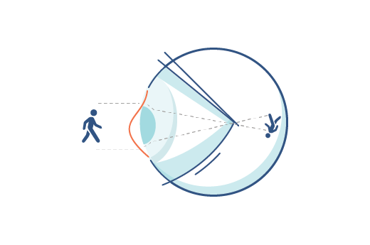 Illustration eines Auges mit Hornhautverkrümmung