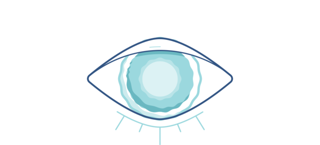 Illustration eines trüben Auges