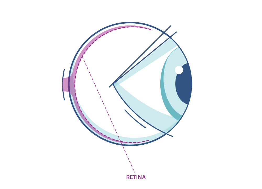 Illustration eines Auges mit Markierung der Netzhaut
