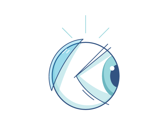 Illustration einer Kontaktlinse, die hinter das Auge rutscht.